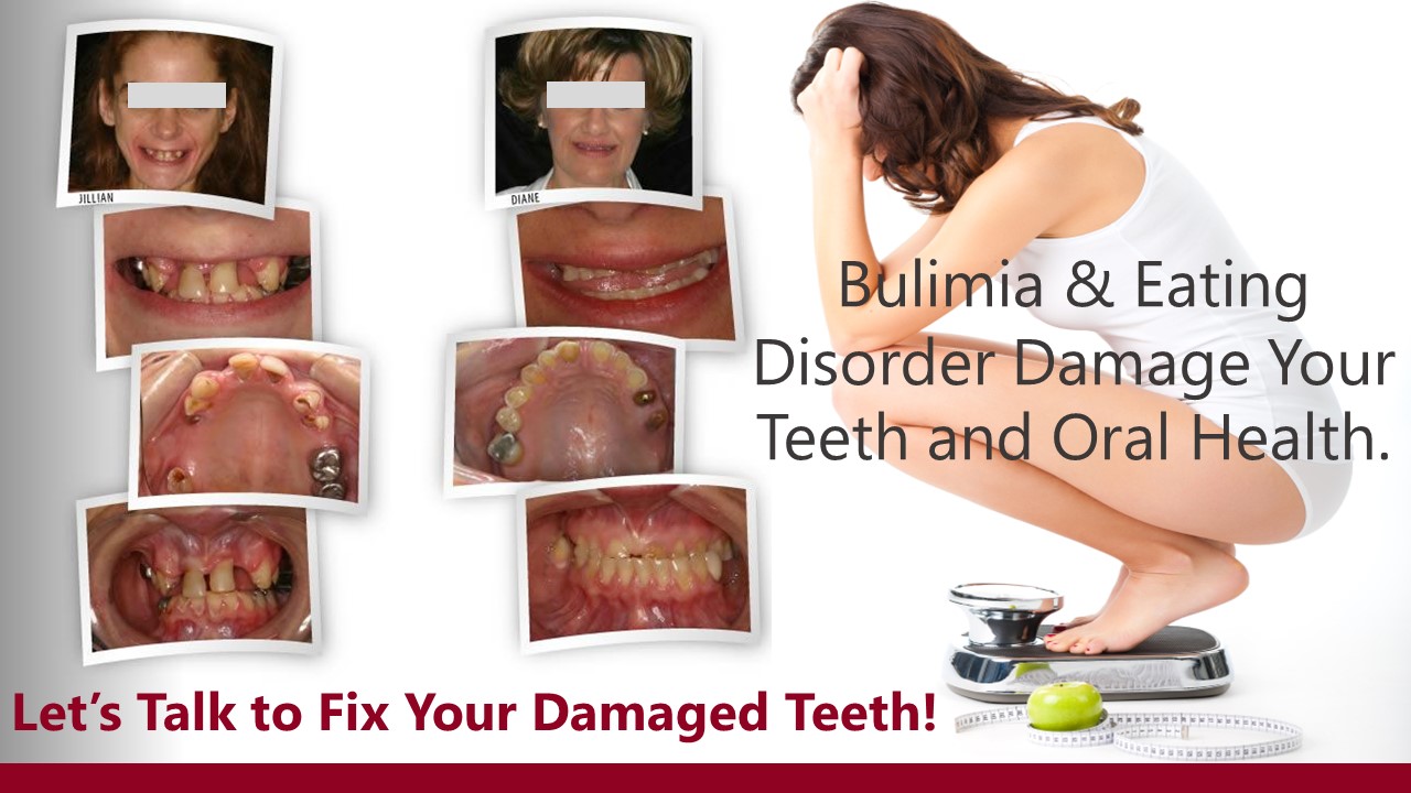 Bulimia Teeth Damage