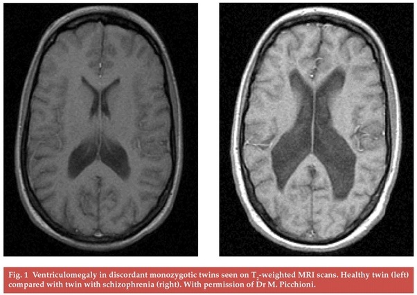 Can a psychosis be seen on a brain scan?