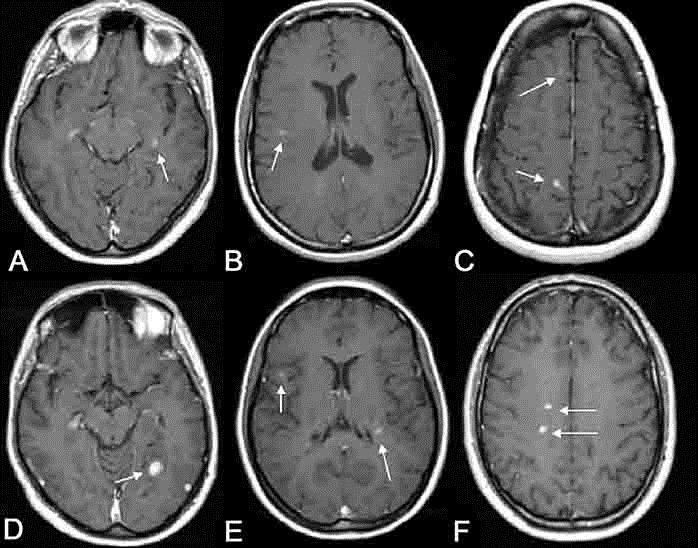 MRI Brain White Spots Cause