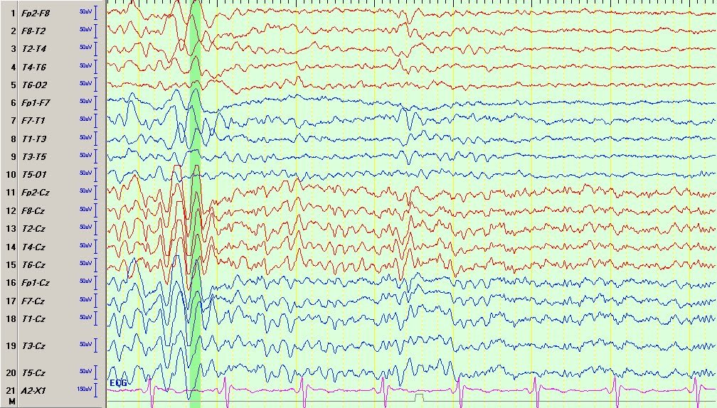 Normal? routine EEGs are not always normal
