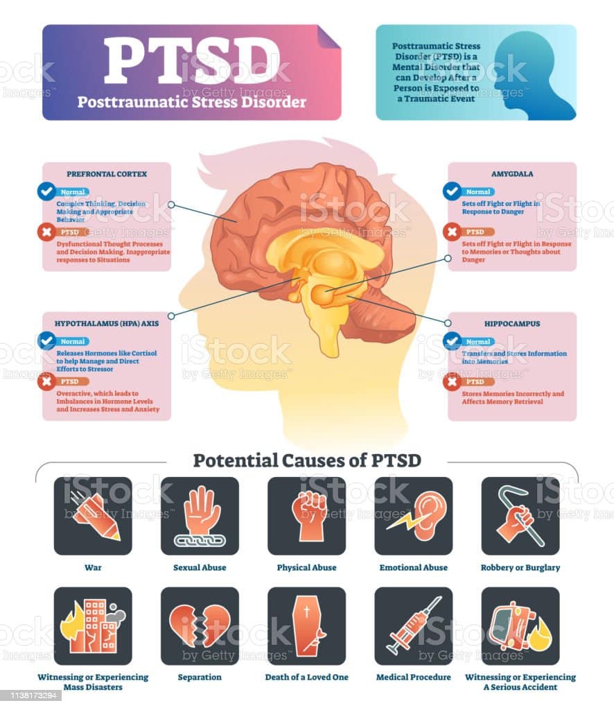 Ptsd Vector Illustration Labeled Anatomical Mental Disorder Causes ...
