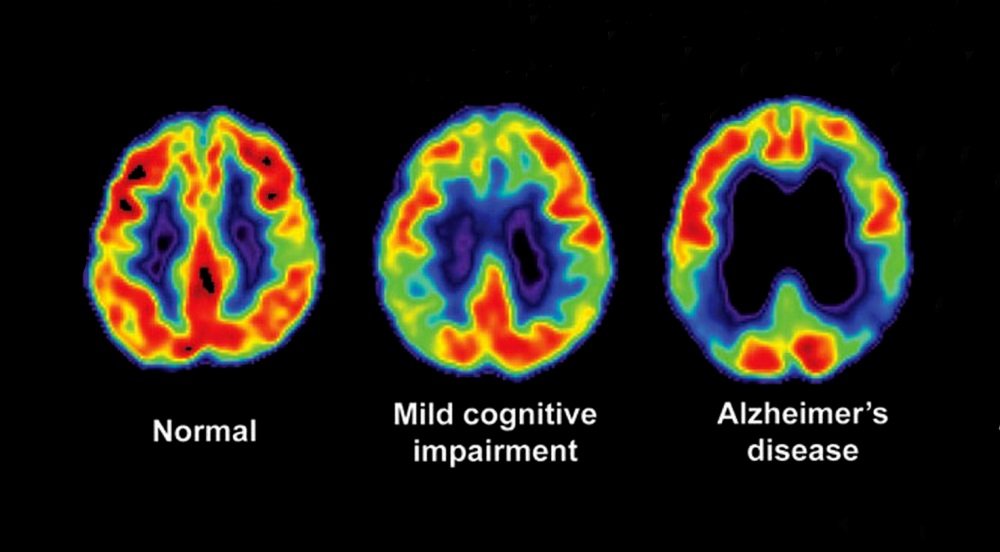 Sleep Quality May Impact Alzheimer